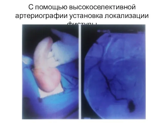 С помощью высокоселективной артериографии установка локализации фистулы
