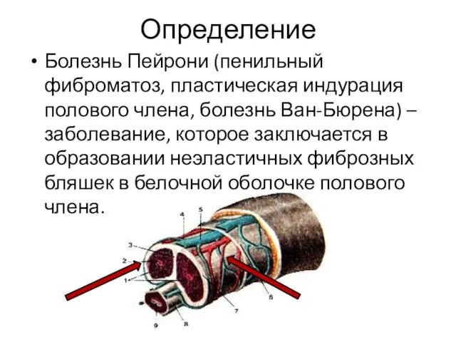 Определение Болезнь Пейрони (пенильный фиброматоз, пластическая индурация полового члена, болезнь Ван-Бюрена)