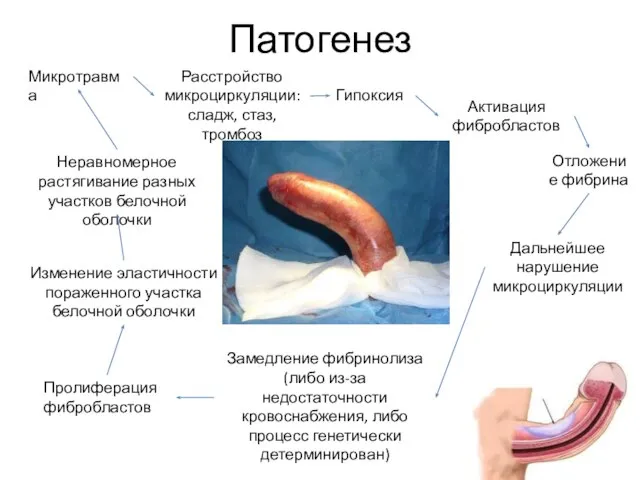 Патогенез Микротравма Расстройство микроциркуляции: сладж, стаз, тромбоз Гипоксия Активация фибробластов Отложение