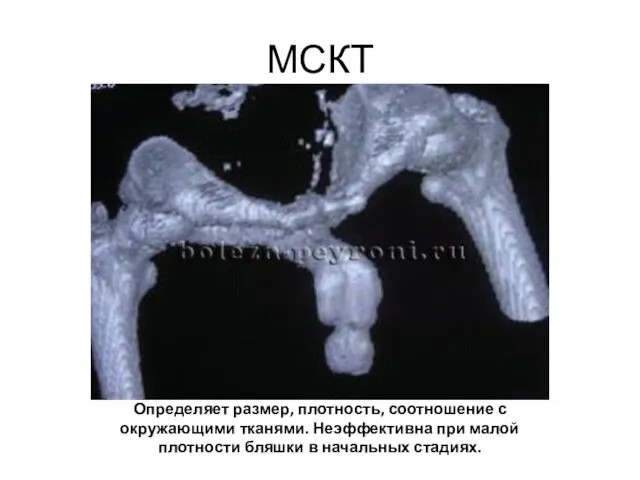 МСКТ Определяет размер, плотность, соотношение с окружающими тканями. Неэффективна при малой плотности бляшки в начальных стадиях.