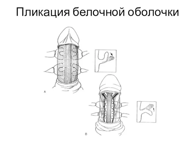 Пликация белочной оболочки