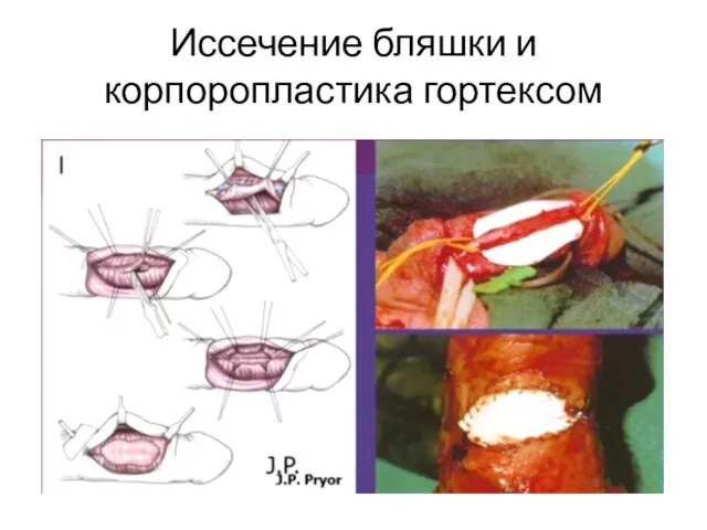 Иссечение бляшки и корпоропластика гортексом