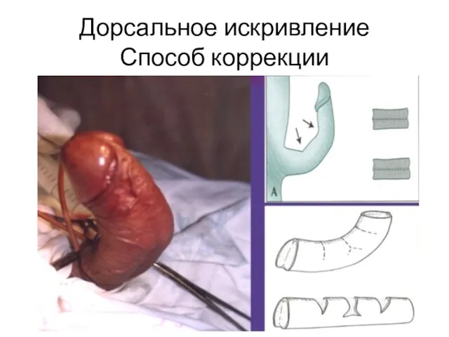 Дорсальное искривление Способ коррекции