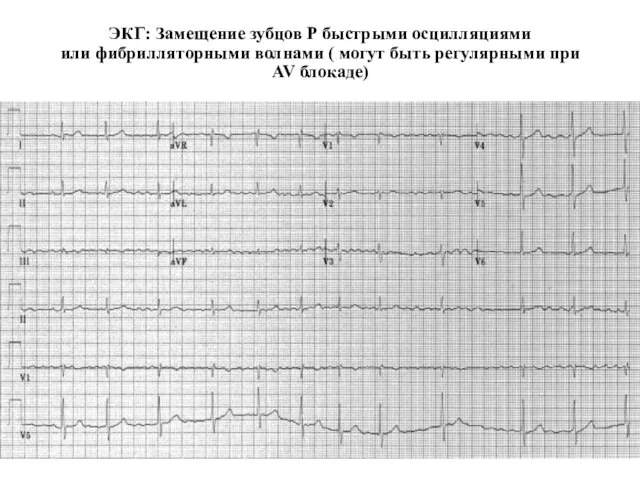 Фибрилляция предсердий ЭКГ: Замещение зубцов Р быстрыми осцилляциями или фибрилляторными волнами