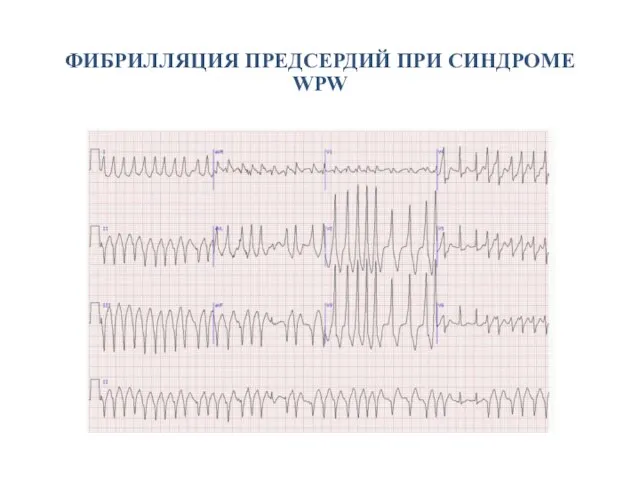 ФИБРИЛЛЯЦИЯ ПРЕДСЕРДИЙ ПРИ СИНДРОМЕ WPW