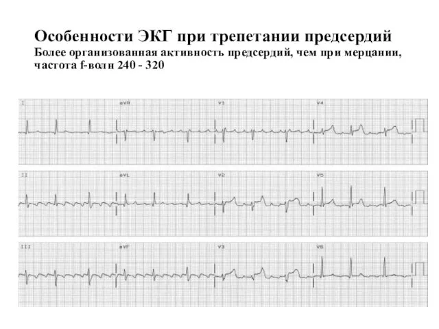 Особенности ЭКГ при трепетании предсердий Более организованная активность предсердий, чем при