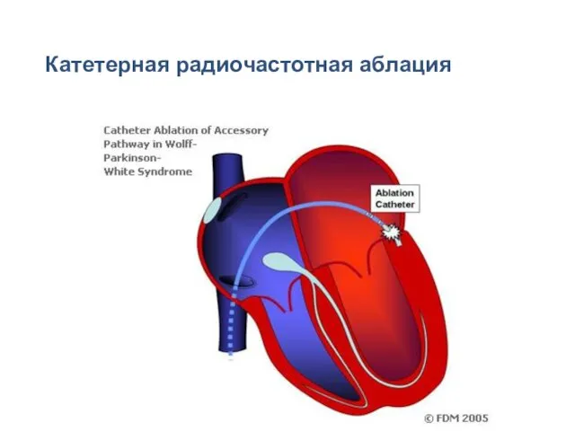 Катетерная радиочастотная аблация