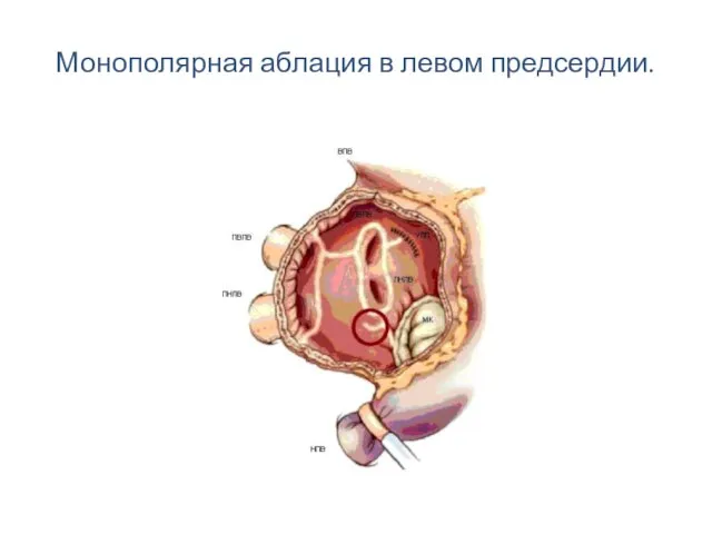 Монополярная аблация в левом предсердии.