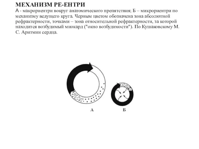 МЕХАНИЗМ РЕ-ЕНТРИ А - макрориентри вокруг анатомического препятствия; Б – микрориентри