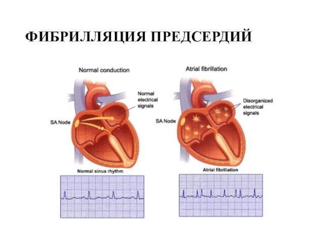 ФИБРИЛЛЯЦИЯ ПРЕДСЕРДИЙ