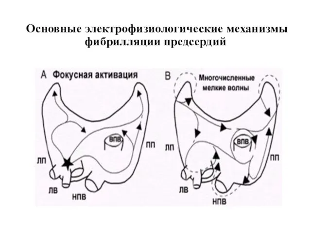 Основные электрофизиологические механизмы фибрилляции предсердий