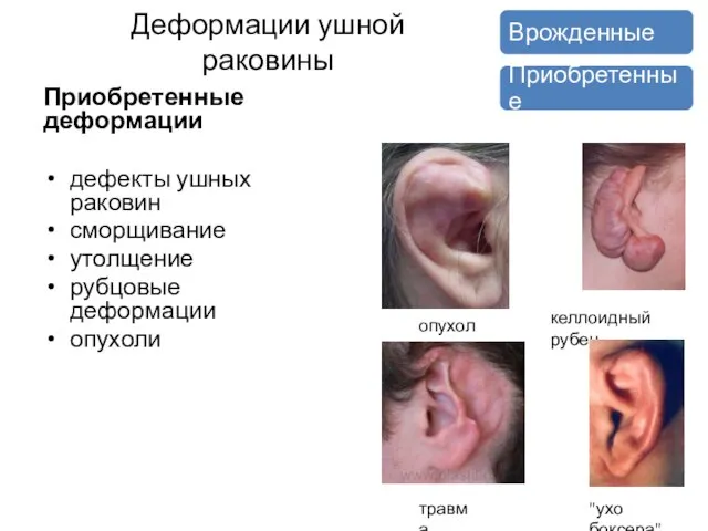 Деформации ушной раковины Приобретенные деформации дефекты ушных раковин сморщивание утолщение рубцовые