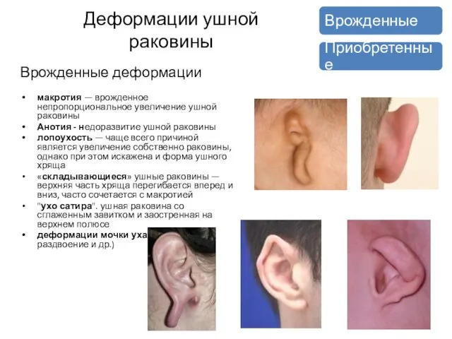 Деформации ушной раковины Врожденные деформации макротия — врожденное непропорциональное увеличение ушной