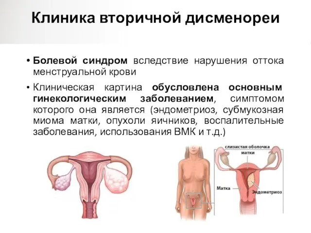 Клиника вторичной дисменореи Болевой синдром вследствие нарушения оттока менструальной крови Клиническая