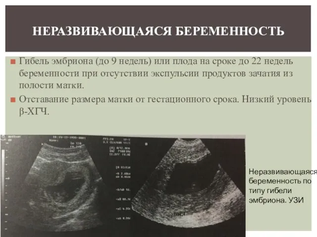 Гибель эмбриона (до 9 недель) или плода на сроке до 22