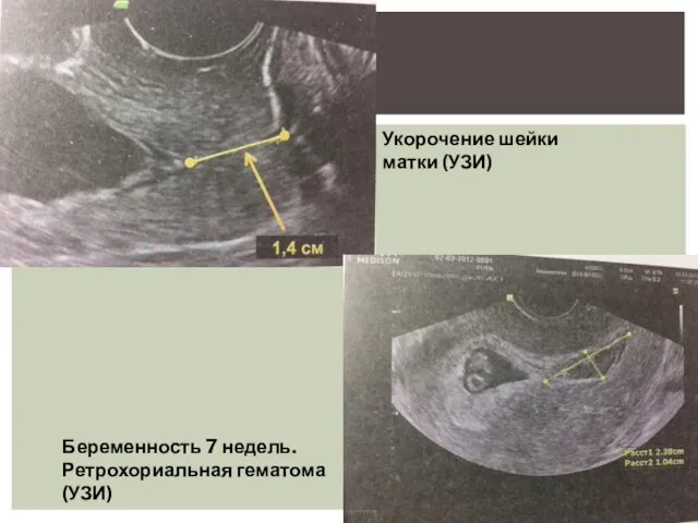 Укорочение шейки матки (УЗИ) Беременность 7 недель. Ретрохориальная гематома (УЗИ)