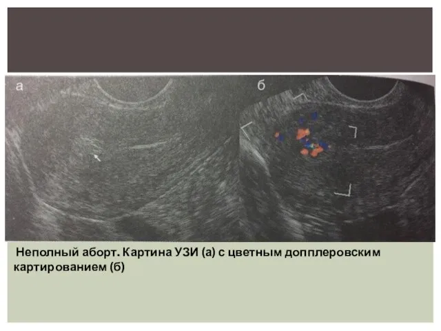 Неполный аборт. Картина УЗИ (а) с цветным допплеровским картированием (б)