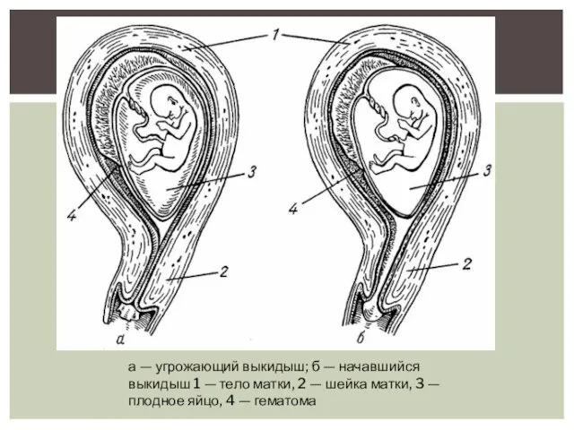 а — угрожающий выкидыш; б — начавшийся выкидыш 1 — тело