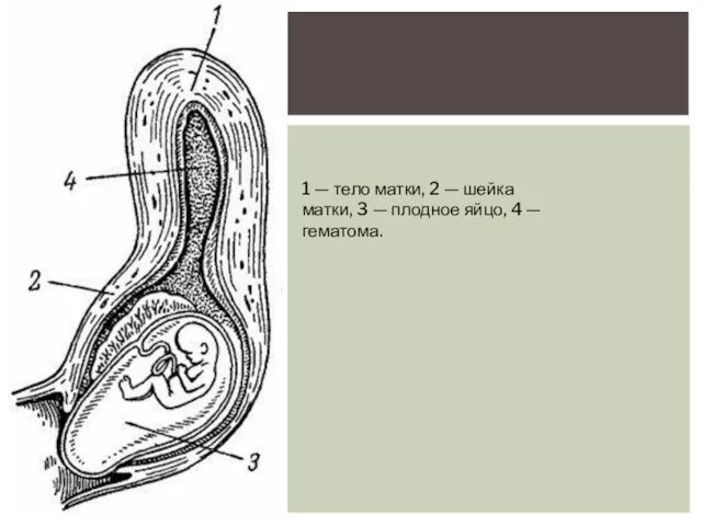 1 — тело матки, 2 — шейка матки, 3 — плодное яйцо, 4 — гематома.