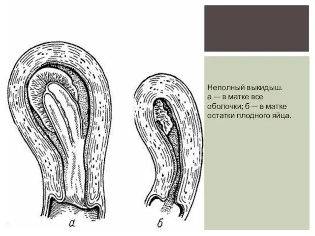 Неполный выкидыш. а — в матке все оболочки; б — в матке остатки плодного яйца.