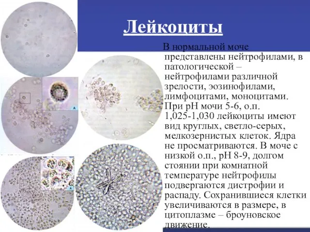 Лейкоциты В нормальной моче представлены нейтрофилами, в патологической – нейтрофилами различной