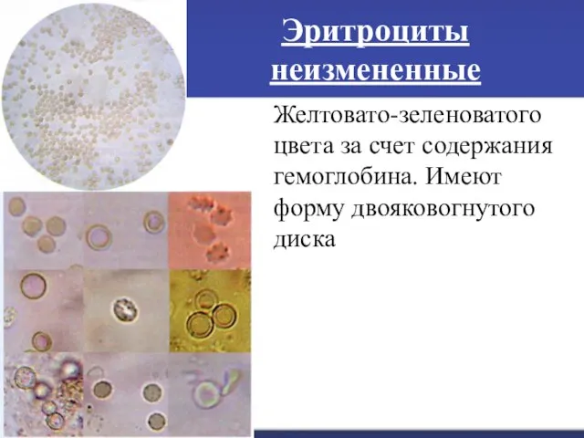 Эритроциты неизмененные Желтовато-зеленоватого цвета за счет содержания гемоглобина. Имеют форму двояковогнутого диска