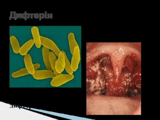 Дифтерія Збудник – дифтерійна бацила