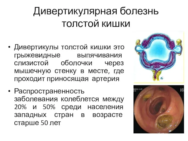 Дивертикулярная болезнь толстой кишки Дивертикулы толстой кишки это грыжевидные выпячивания слизистой