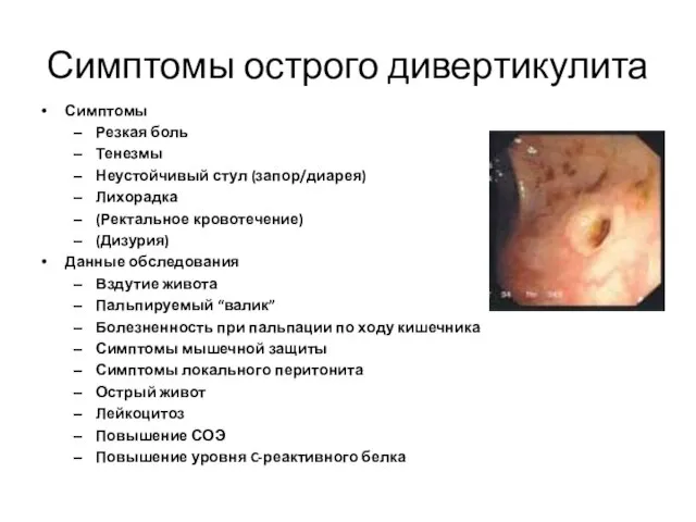 Симптомы острого дивертикулита Симптомы Резкая боль Тенезмы Неустойчивый стул (запор/диарея) Лихорадка