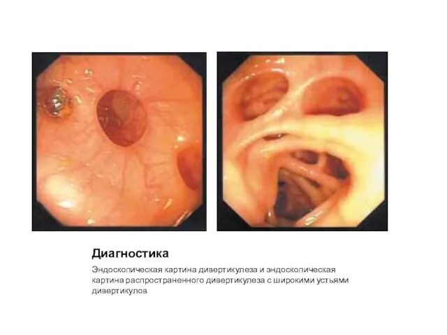 Диагностика Эндоскопическая картина дивертикулеза и эндоскопическая картина распространенного дивертикулеза с широкими устьями дивертикулов