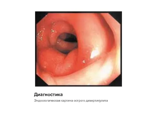 Диагностика Эндоскопическая картина острого дивертикулита