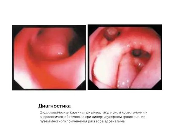 Диагностика Эндоскопическая картина при дивертикулярном кровотечении и эндоскопический гемостаз при дивертикулярном