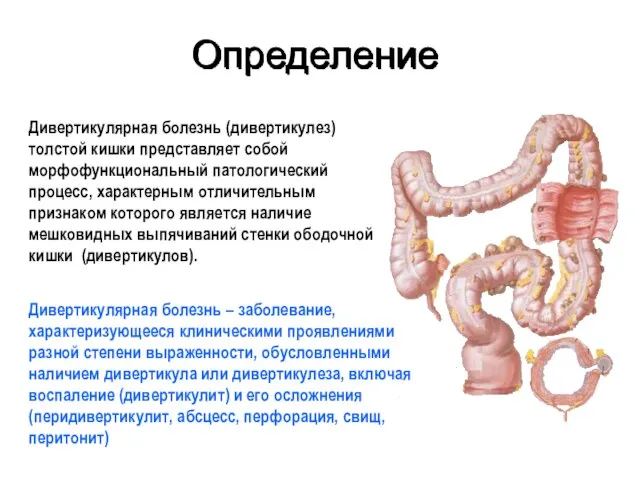 Определение Дивертикулярная болезнь (дивертикулез) толстой кишки представляет собой морфофункциональный патологический процесс,