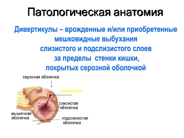 Патологическая анатомия Дивертикулы – врожденные и/или приобретенные мешковидные выбухания слизистого и