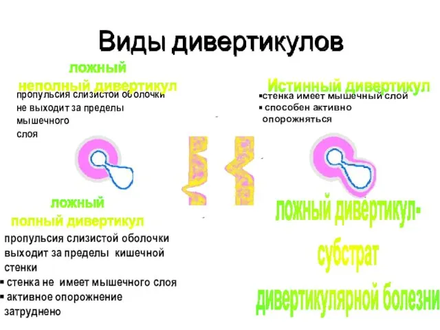 Виды дивертикулов пропульсия слизистой оболочки не выходит за пределы мышечного слоя