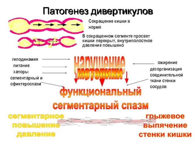 Патогенез дивертикулов Сокращение кишки в норме В сокращенном сегменте просвет кишки