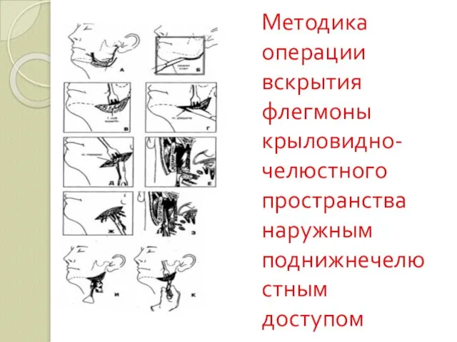 Методика операции вскрытия флегмоны крыловидно-челюстного пространства наружным поднижнечелюстным доступом