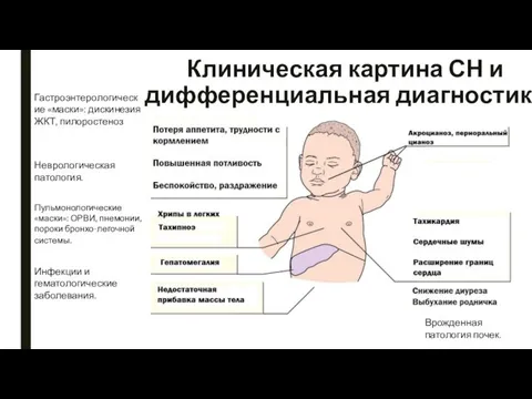 Клиническая картина СН и дифференциальная диагностика Гастроэнтерологические «маски»: дискинезия ЖКТ, пилоростеноз