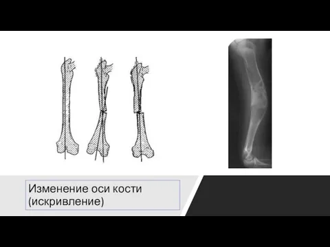 Изменение оси кости (искривление)