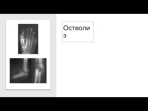 Остеолиз