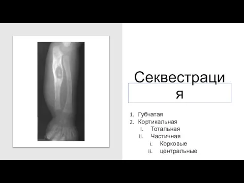 Секвестрация Губчатая Кортикальная Тотальная Частичная Корковые центральные