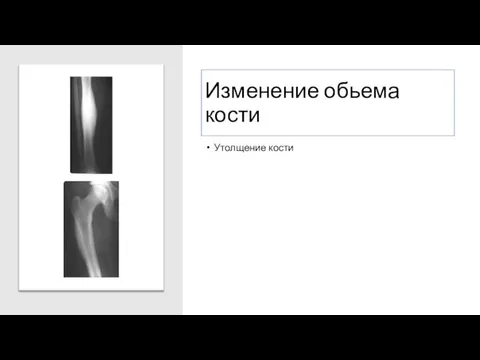 Изменение обьема кости Утолщение кости