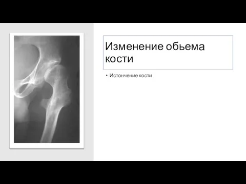 Изменение обьема кости Истончение кости