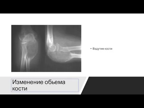 Изменение обьема кости Вздутие кости