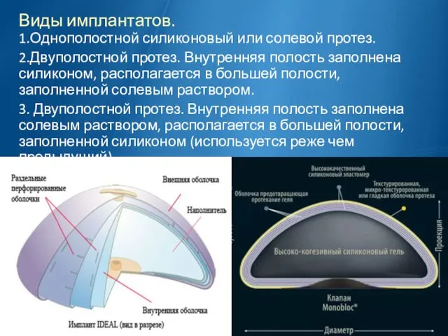 Виды имплантатов. 1.Однополостной силиконовый или солевой протез. 2.Двуполостной протез. Внутренняя полость