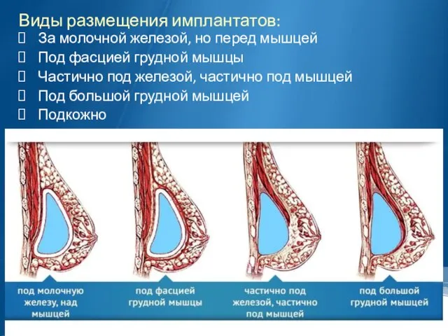 Виды размещения имплантатов: За молочной железой, но перед мышцей Под фасцией