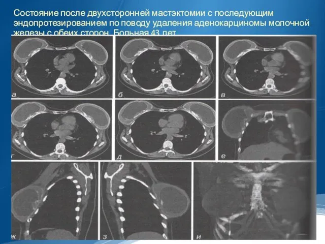 Состояние после двухсторонней мастэктомии с последующим эндопротезированием по поводу удаления аденокарциномы