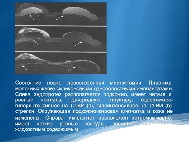 Состояние после левосторонней мастэктомии. Пластика молочных желез силиконовыми однополостными имплантатами. Слева