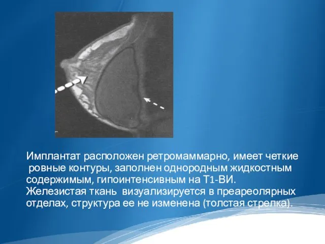 Имплантат расположен ретромаммарно, имеет четкие ровные контуры, заполнен однородным жидкостным содержимым,