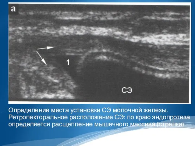 Определение места установки СЭ молочной железы. Ретропекторальное расположение СЭ: по краю